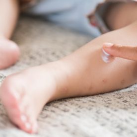 A parent puts calamine lotion on their child's leg.